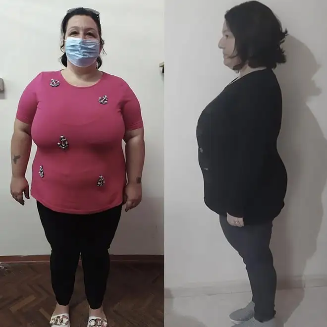 risultati-del-palloncino-gastrico-allurion-testimonianza-3 risultati del palloncino gastrico allurion per donna di 40 anni