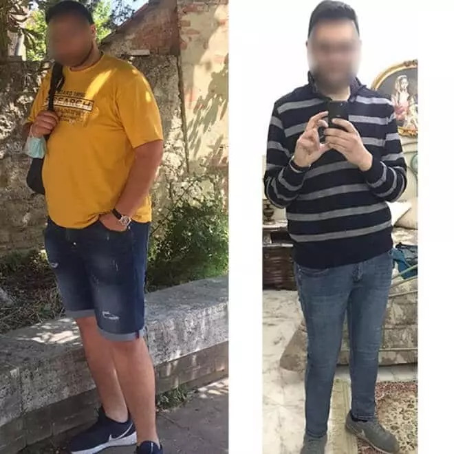 risultati-del-palloncino-gastrico-allurion-testimonianza-4 risultati del palloncino gastrico allurion per uomo di 22 anni
